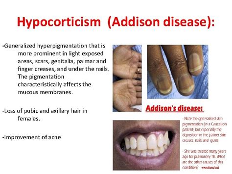 Addison S Disease Tidaxx