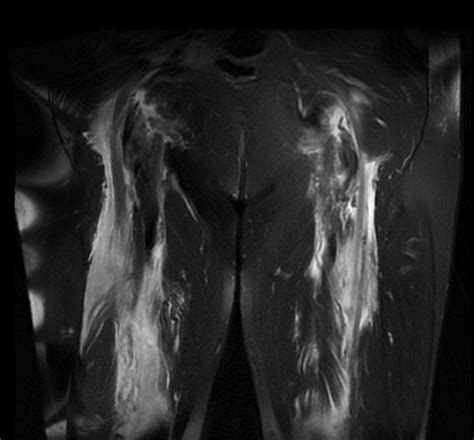 Patología Hip Tendón Fractura Bilateral Del Tendón Bíceps Femoral
