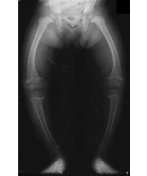 Anteroposterior View Of The 2 Yo Rickets Child Legs By Download