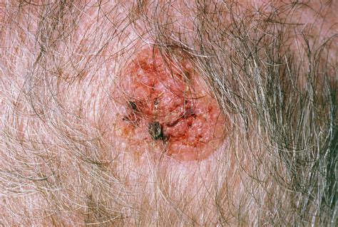 Squamous Cell Carcinoma On Scalp Stock Image M131 0265 Science
