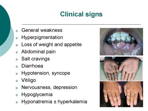 Hypocortisolism Addisons Disease Online Presentation