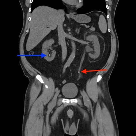 Kidney stones or kidney stone fragments can also pass through this system of tubes and into the ureter, causing serious complications. Queens of the Stone Age | Neighborhood Radiologist