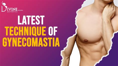 How Gynecomastia 360 Surgery Is Done With The 4dx Technique Latest Technique Of Gynecomastia