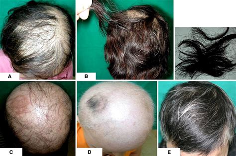 Acute Diffuse And Total Alopecia A New Subtype Of Alopecia Areata With