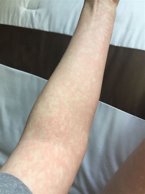 Lamictal Rash Mouth