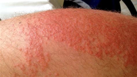 Skin Rashes On Body