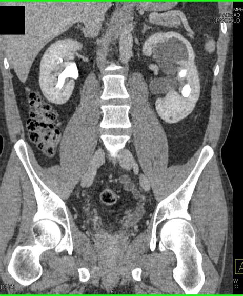 Obstructed Left Ureter With Ectopic Insertion Genitourinary Case