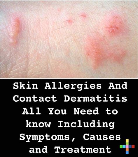 Itchy Skin Rashes Identification
