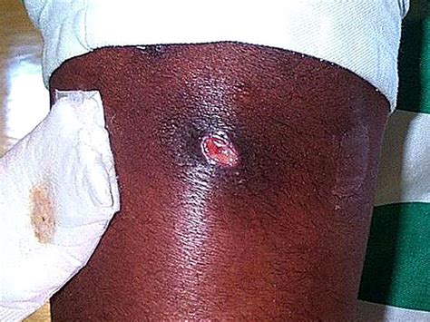 Deadly Skin Infection 12 Graphic Photos That Could Save Your Life