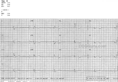 Left Posterior Fascicular Block Ecg Guru Instructor Resources