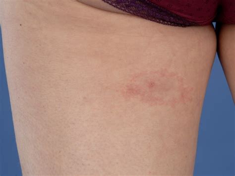 The Characteristic Bullseye Rash For Lyme Disease Innatoss