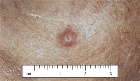 Merkel Cell Carcinoma Of The Head And Neck Effect Of Surgical Excision