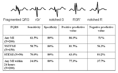 Abstract 2484 Fragmented Qrs On A 12 Lead Ecg Is A Sign Of Acute Or