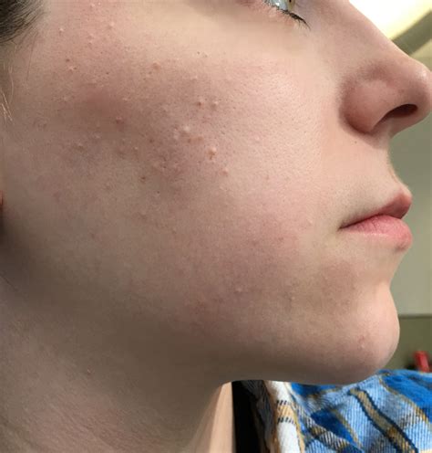 Skin Bumps On Face