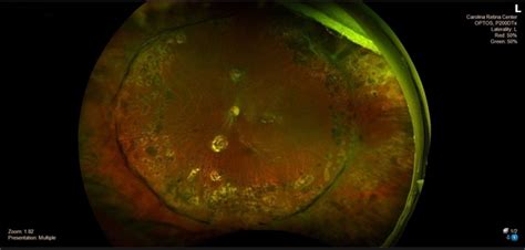 Scleral Buckle Retina Image Bank
