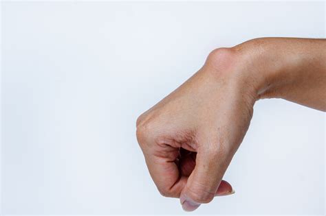 Many people note a large soft bump that can be pushed on a little with some. ganglion cyst | Greater Chesapeake Hand Specialists