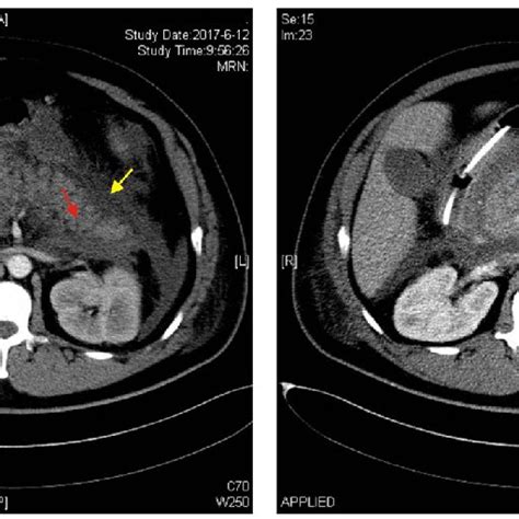 Abdominal Computed Tomography Ct Showing The Enlarged Pancreas With