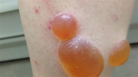How To Treat Disturbing Tropical Rashes And Skin Parasites Steven And