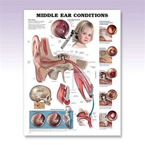 Otolaryngology Middle Ear Conditions Anatomy Poster For