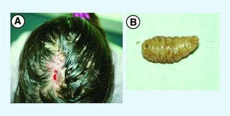Myiasis Due To Dermatobia Hominis In A Traveler From Latin America Download Scientific Diagram