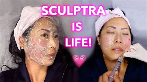 SCULPTRA Updates Best Filler For Facial Rejuvenation LEI CLINIC YouTube