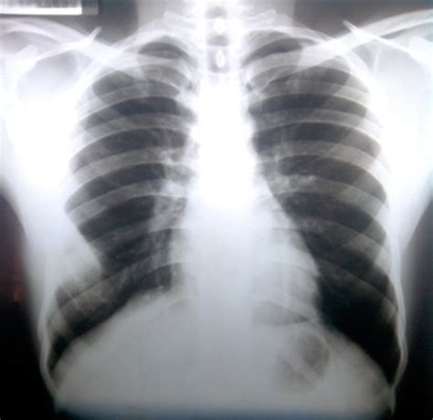 Chest X Ray Showing Tumor Of 6 Th Rib On Right Side Download