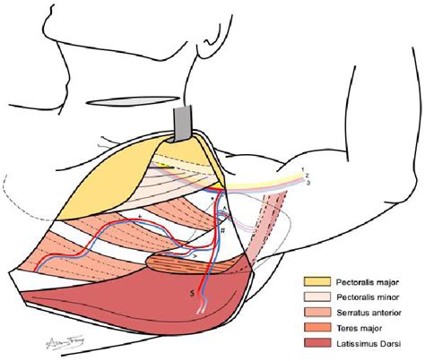 Figure From Revisiting Pedicled Latissimus Dorsi Flaps In Head And