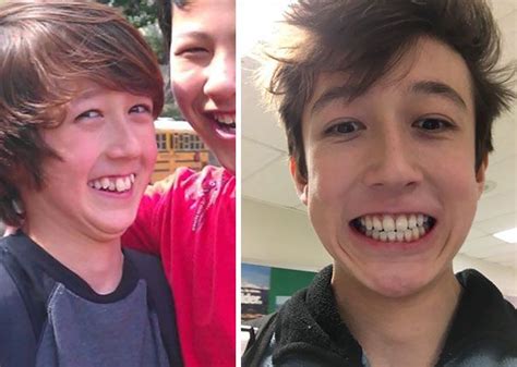 Before And After 2 Years And 10 Months Braces Before And After After