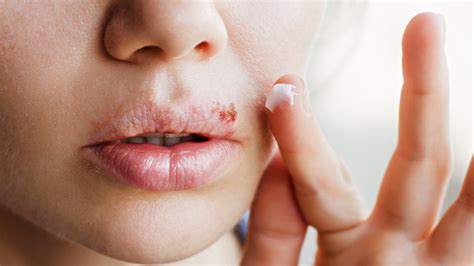 Cold Sores Explained Causes Symptoms And Treatments
