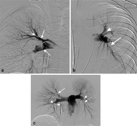 Large Bore Suction Thrombectomy Therapy For Massive Pulmonary Embolism On Extracorporeal