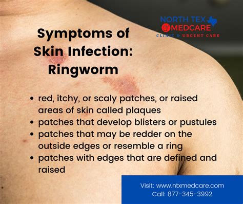 Ringworm Is A Fungal Infection Of The Skin Symptoms Vary Depending On
