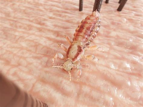 Parasitic Louse On Human Head Skin Digital Illustration — Sucking