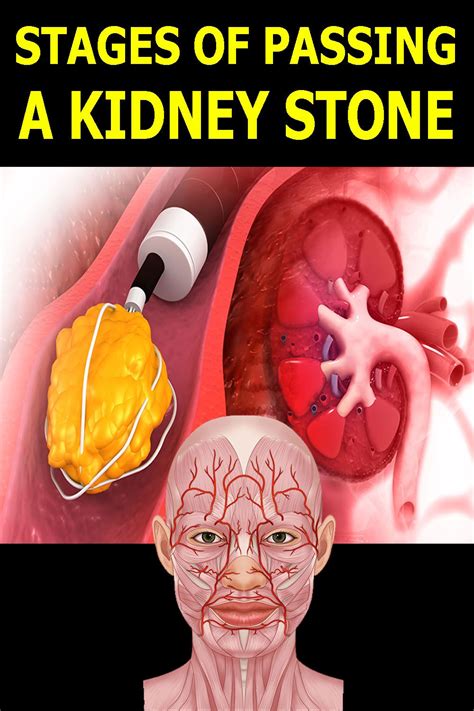 The 4 Stages Of Passing A Kidney Stone Recognizing Early Signs Artofit
