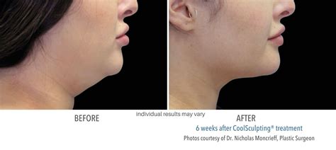 Coolsculpting Chin Double Chin Reduction — Emerson Medical