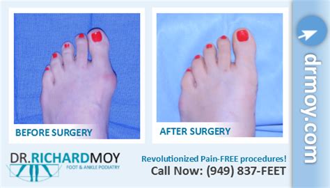 Before And After Bunion Surgery Bunion How To Treat Bunions
