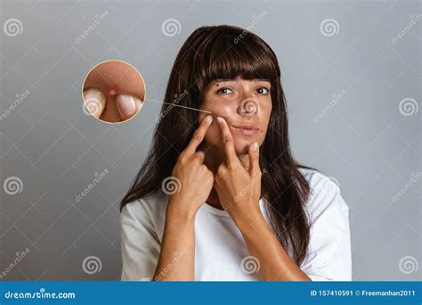 Acne And Cosmetology A Tanned Young Woman Squeezes A Pimple On Her