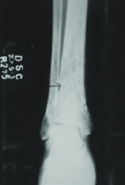 X Ray Ankle Joint Showing Lytic Lesion On The Tiba And The Right And