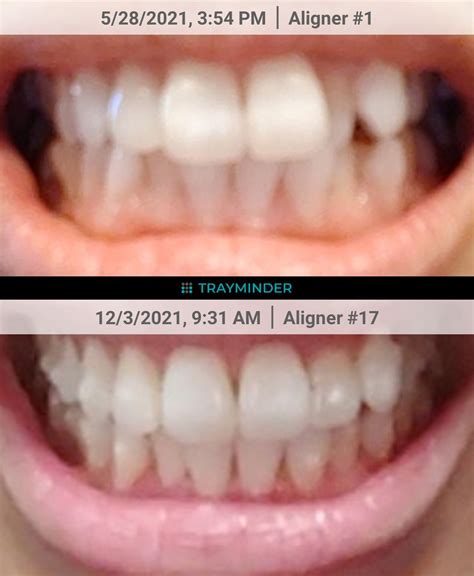 About 6 Months In I Love The Progress Rinvisalign