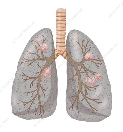 Lung Cancer Illustration Stock Image C0276592 Science Photo Library