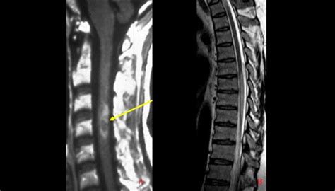 Since their promulgation, there have been substantial relevant advances in knowledge, including the 2017 revisions of the. MS Mimics on MRI