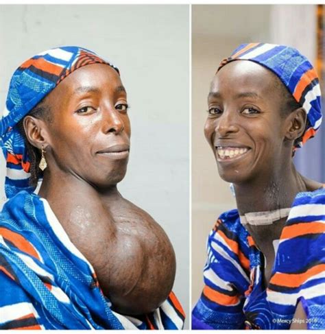 She Received Surgery Onboard The Africamercy To Remove The Goiter And