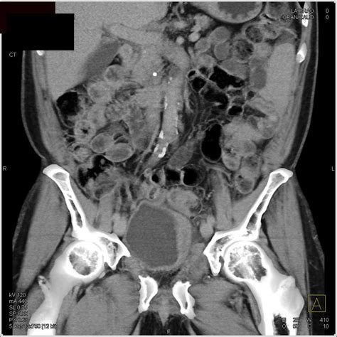 Aggressive Bladder Cancer With Pelvic Side Wall Invasion