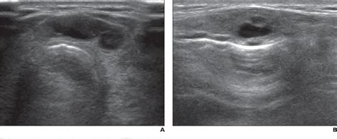 Thyroid Isthmus Ultrasound