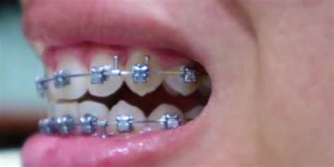 As with traditional braces, the cost of the invisalign. Colored Braces Cost More | Colorpaints.co