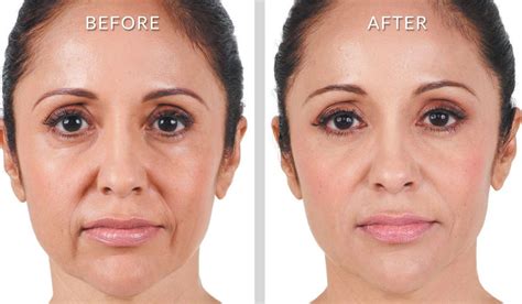 Non Surgical Treatment For Nasolabial Folds Marionette Lines