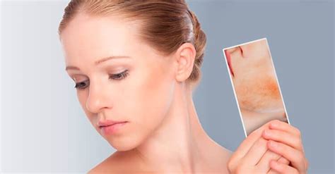 Pregnancy Acne: Natural Remedies