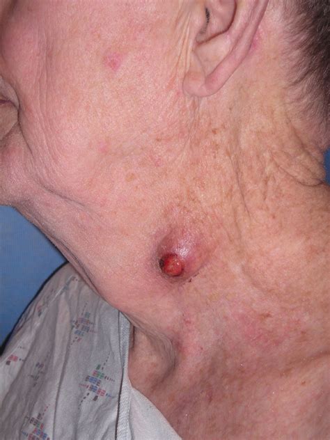 Keratin Granuloma Inflamed Or Ruptured Cyst Inflamed Or Ruptured