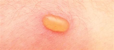 Blister Beetle Bite Dermatitis And Rash Symptoms