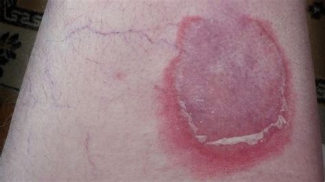Pemphigoid Types Causes And Symptoms