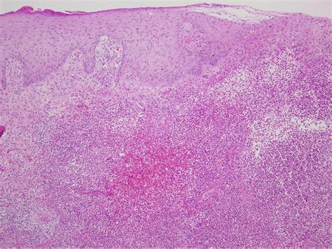 Ecthyma Gangrenosum Histology